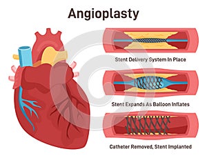 Angioplasty. Stent delivery and implantation. Deflated balloon catheter