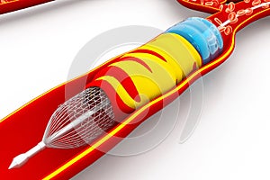 Angioplasty with stent placement