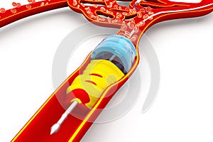 Angioplasty with stent placement