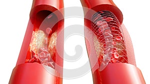 Angioplasty with stent placement- 3D rendering