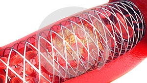 Angioplasty with stent placement - 3D rendering photo