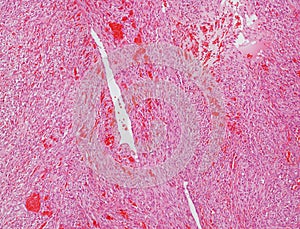 Angiosarcoma micrograph