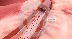 Angiotensin II Receptor Blockers, Decreased Blood Pressure