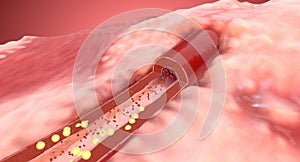 Angiotensin II Receptor Blockers, Decreased Blood Pressure