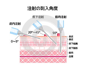 Angles for Inserting Injections vector illustration