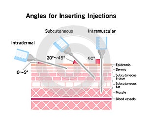 Angles for Inserting Injections vector illustration