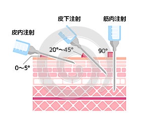 Angles for Inserting Injections vector illustration