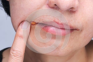 Angular cheilitis ,common inflammation of the lips