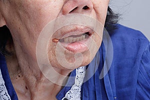 Angular cheilitis or inflammation of the lips