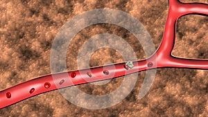 Animation of the formation of thrombosis