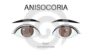 The Anisocoria eye photo