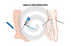 Ankle arthroscopy poster photo