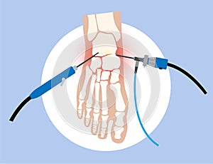 Ankle arthroscopy poster photo