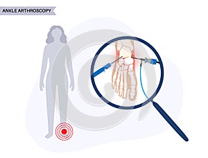 Ankle arthroscopy poster photo