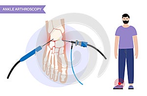 Ankle arthroscopy poster photo