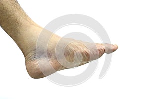 Ankle bruises, injuries