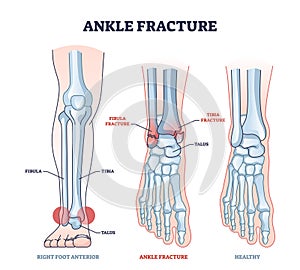 Ankle fracture and right foot anterior trauma medical view outline diagram