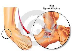 Ankle ligament rupture photo
