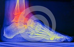 ankle pain illustration, x ray