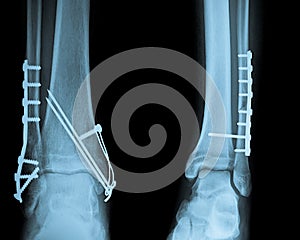 Ankle X ray with Osteosynthesis