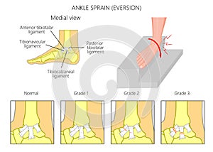 Ankle sprain.Eversion