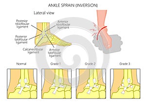 Ankle sprain.Inversion photo