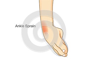 Ankle sprain and swelled. photo