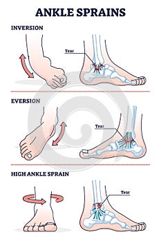 Ankle sprains situations with inversion and eversion injury outline diagram