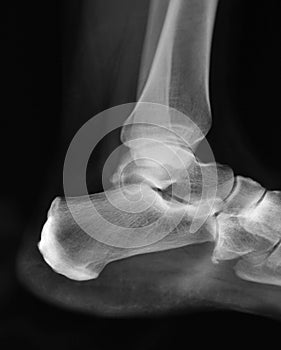 Ankle X-ray