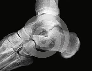 Ankle x-ray