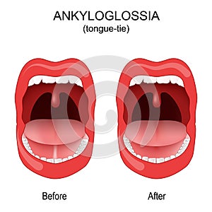 Ankyloglossia. tongue-tie. congenital oral anomaly