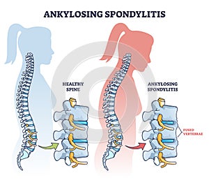 Ankylosing spondylitis as inflammatory spine bone disease outline diagram