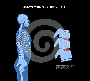 Ankylosing spondylitis disease