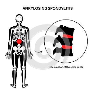 Ankylosing spondylitis disease