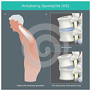 Ankylosing spondylitis. Human spine.