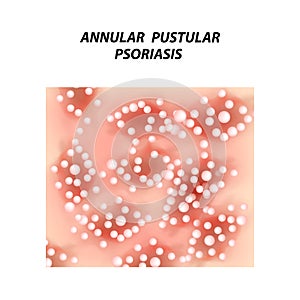 Annular pustular psoriasis. Eczema, dermatitis skin disease psoriasis. Infographics. Vector illustration on isolated