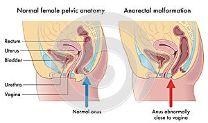 Anorectal malformation