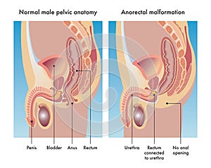  Anorectal Malformation Illustration