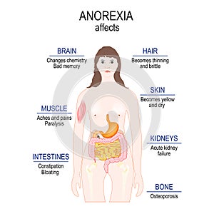 Anorexia nervosa is an eating disorder. low weight. Anorexia affects photo