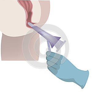 Anoscopy. Diagram with medical procedure.