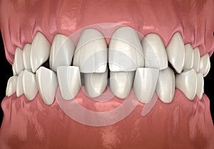 Anterior crossbite dental occlusion  Malocclusion of teeth . Medically accurate tooth 3D illustration photo