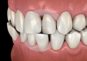 Anterior crossbite dental occlusion  Malocclusion of teeth . Medically accurate tooth 3D illustration photo
