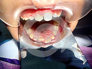 The anterior crossbite of front tooth in an Asian child with the photo