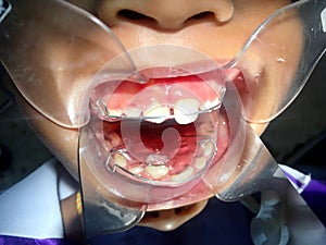 The anterior crossbite of front tooth in an Asian child with the photo