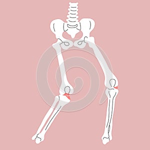 Anterior cruciate ligament ACL Injuries