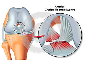 Anterior cruciate ligament rupture photo