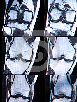 Anterior cruciate ligament tear seen on knee MRI.