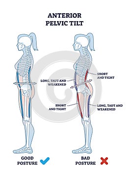 Anterior pelvic tilt or APT as pelvis abnormal posture outline diagram