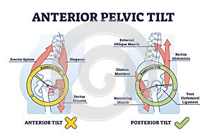 Anterior pelvic tilt model compared with posterior in labeled outline diagram