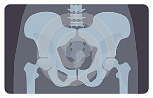 Anterior radiograph of human pelvis or hip bone with lumbar part. X-ray picture or image of human skeletal system, front